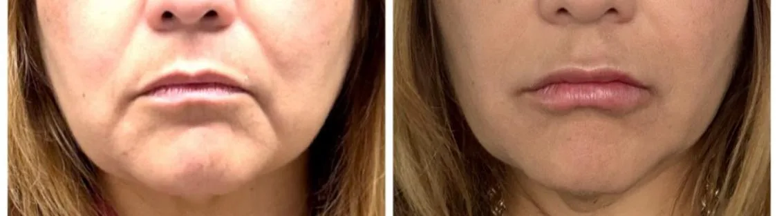 Antes y después · firmeza facial