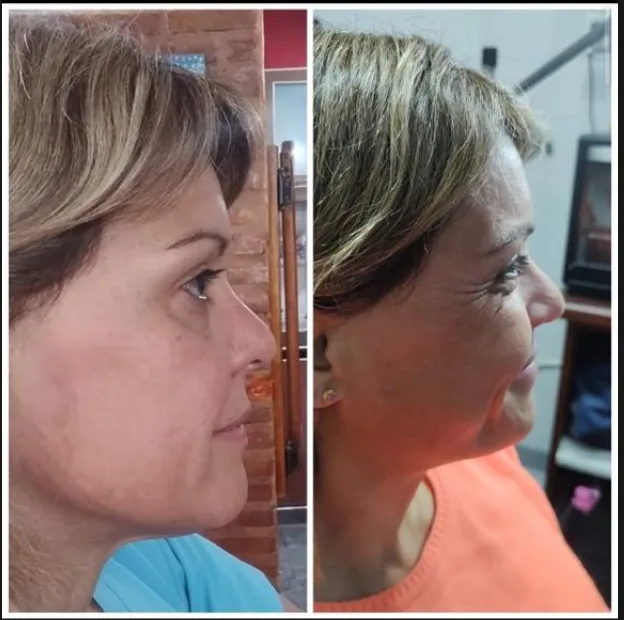 Antes y después · firmeza facial