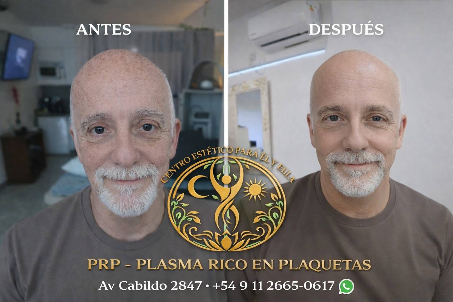 PRP plasma rico en plaquetas · antes y después