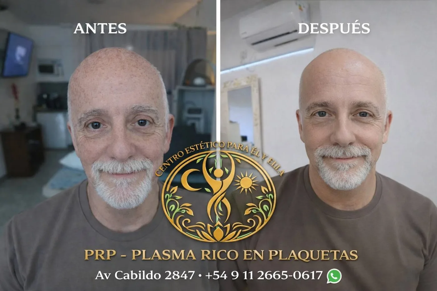 PRP plasma rico en plaquetas · antes y después