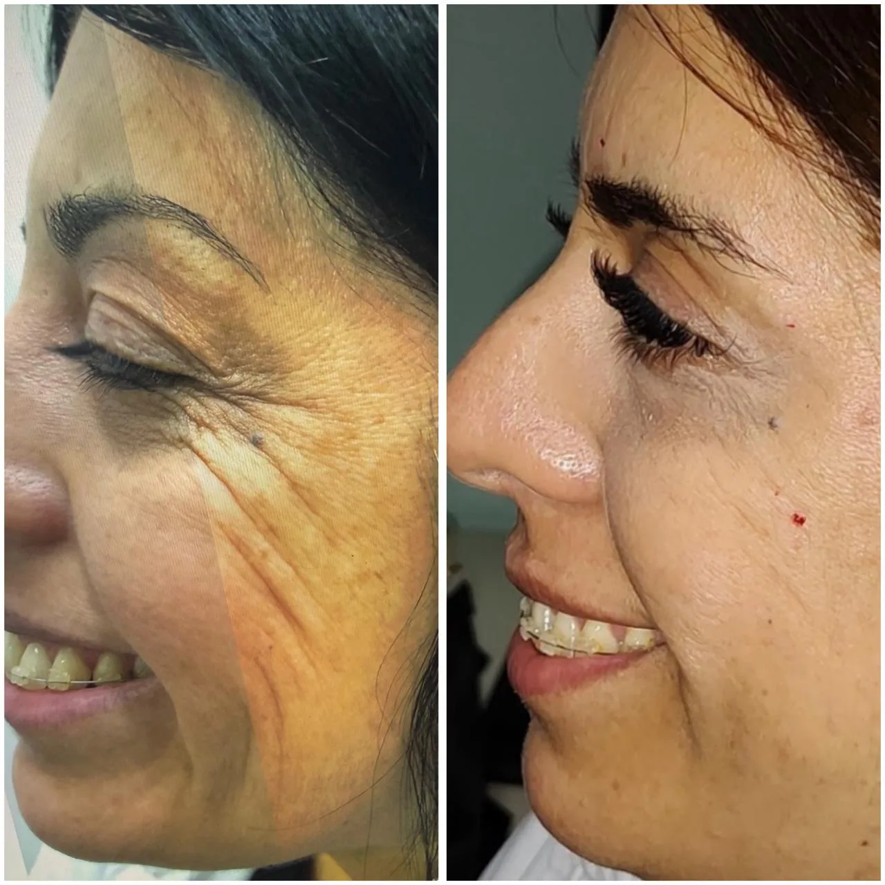 Antes y después de rejuvenecimiento facial en cliente real