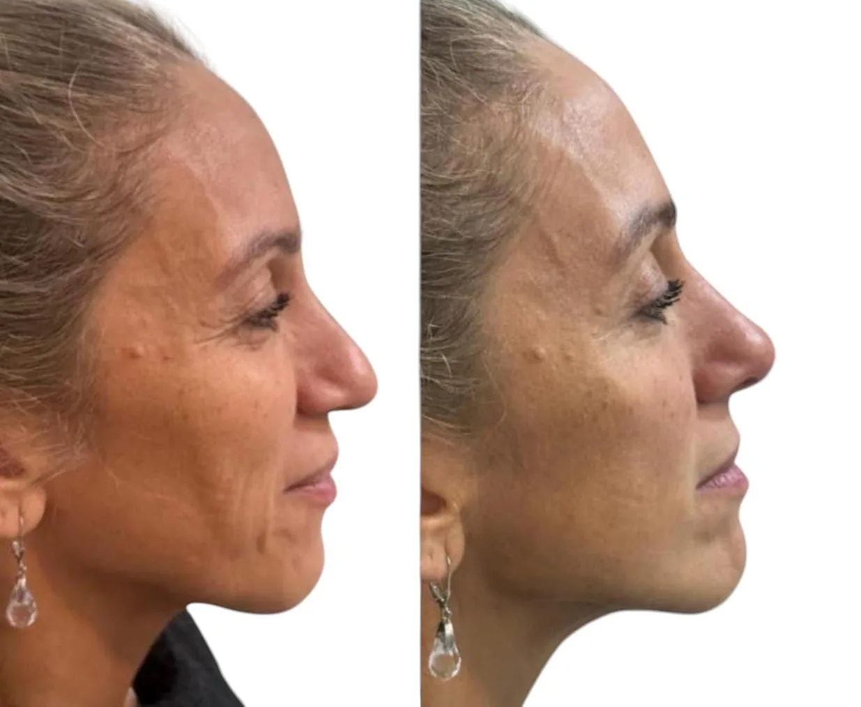 Antes y después · rejuvenecimiento facial